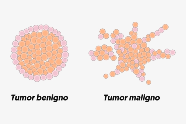 Tumor benigno es cancer